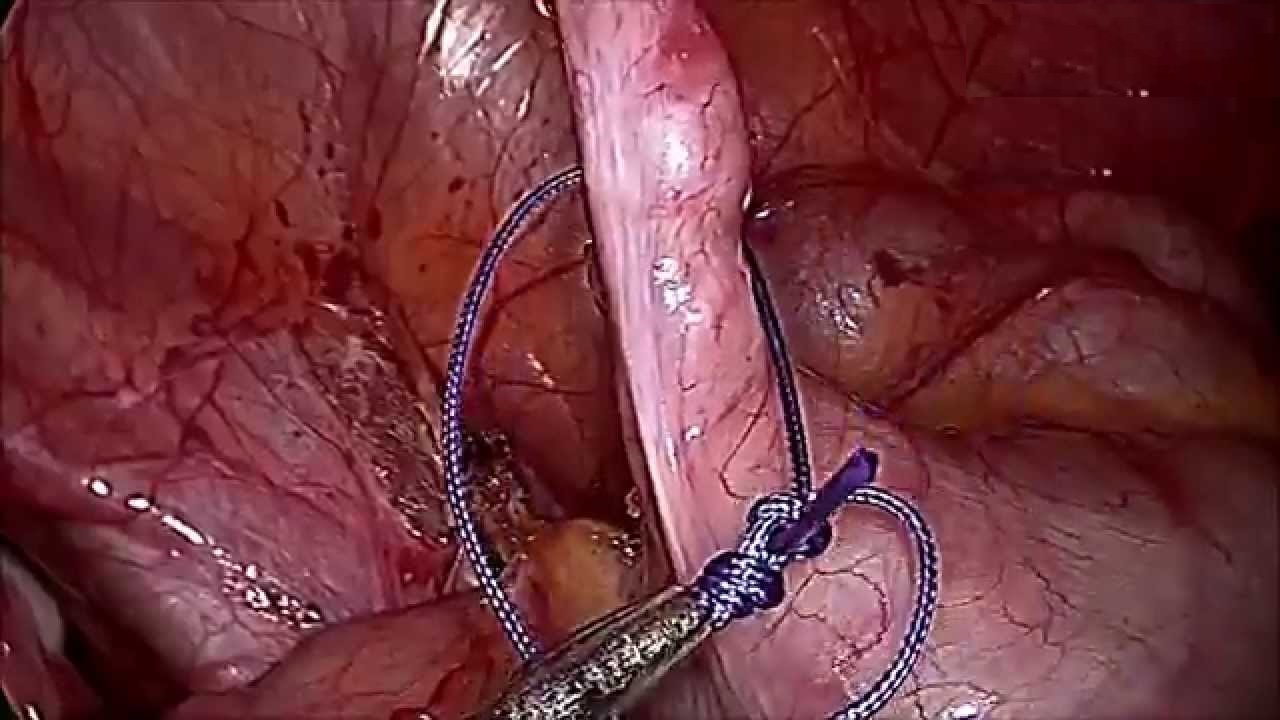 Laparoscopic appendicetomy using endoloop 